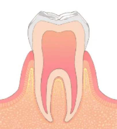 C0／初期むし歯