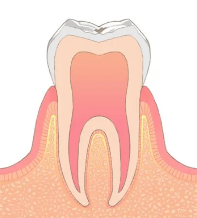 C2／象牙質のむし歯